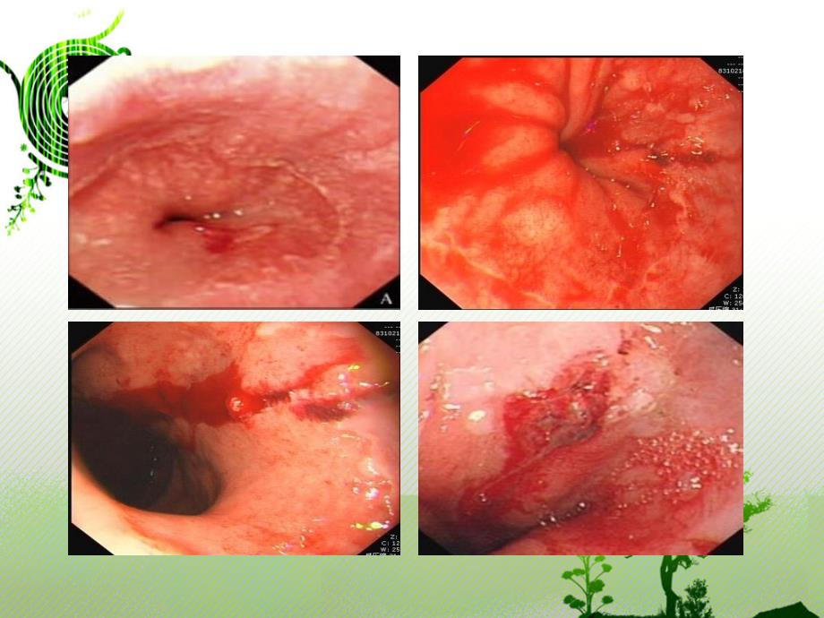 贲门粘膜撕裂课件12_第3页